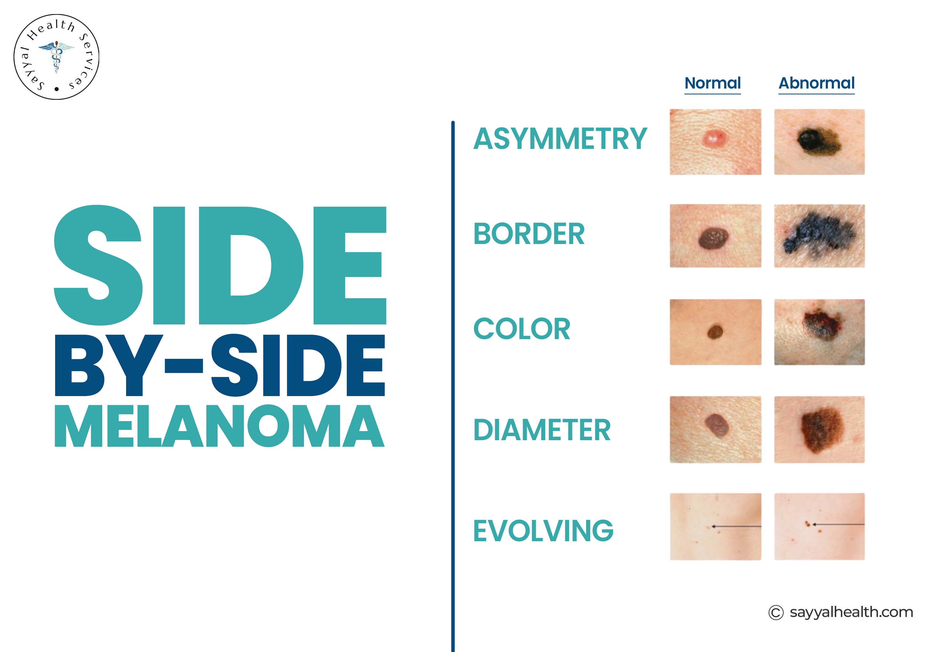 ABCDE melanoma warning signs chart comparing normal vs abnormal moles